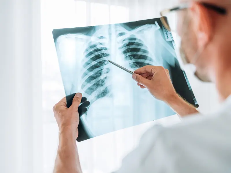Survival outcomes in patients with lung cancer following lung transplantation